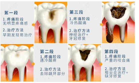 大牙烂到什么程度必须拔牙?龋齿是补好还是拔掉好?