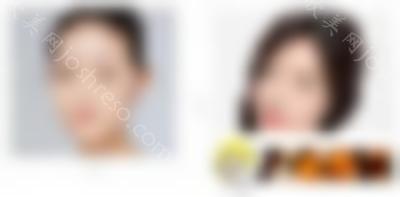 半肋骨隆鼻搞定后好长时间可化妆