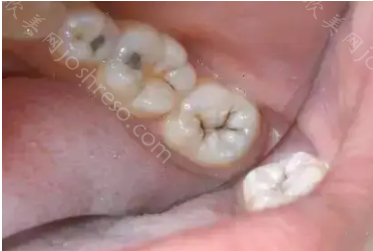 浅龋齿医生为什么不建议补牙?龋齿不补多久会烂掉?
