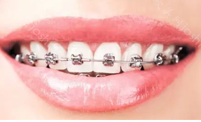 虎牙长在牙龈上怎么矫正?看虎牙矫正效果图