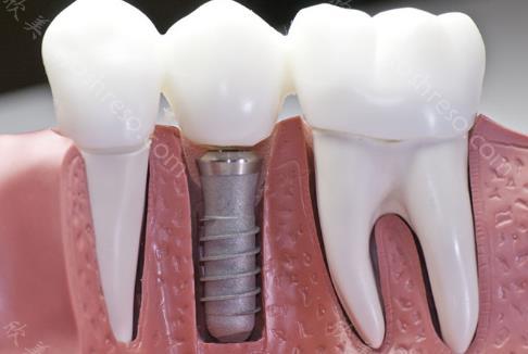 2023超全西安种牙价格表,西安哪些医院做种植牙好?