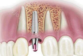 温州种植牙医院哪家好？温州植牙一颗收费要多少钱？