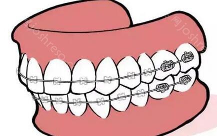 无锡有没有人在华美整牙的啊？无锡矫正牙齿大概多少钱？