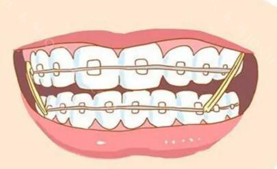 沈阳口腔医院牙齿矫正多少钱？沈阳矫正牙齿好医院分享！