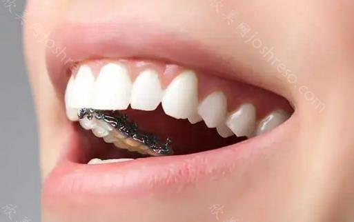 常州孩子牙齿矫正费用大概得多少钱？常州mrc矫正器贵不贵？