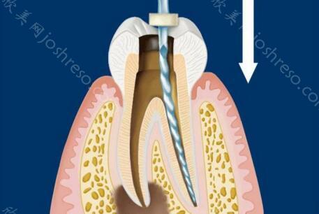 长春根管治疗一颗牙齿多少钱？看看长春当地技术好还不贵的牙科！