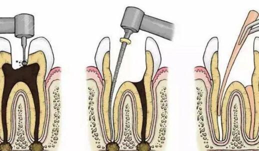 长春根管治疗一颗牙齿多少钱？看看长春当地技术好还不贵的牙科！