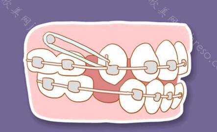 成都口腔医院正畸价格曝光！成都口腔医院做正畸技术怎么样？