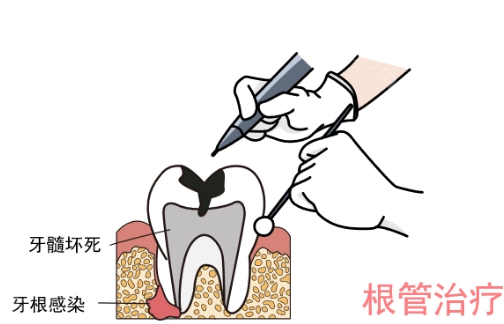 为什么说根管治疗不好?根管治疗后必须要戴牙套吗?