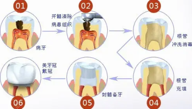 为什么说根管治疗不好?根管治疗后必须要戴牙套吗?