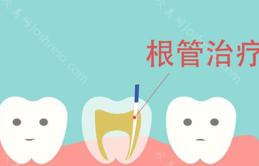 根管治疗牙神经抽出步骤过程图，看完本文你就知晓