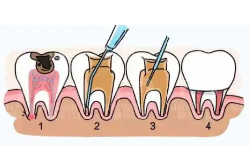 根管治疗牙神经抽出步骤过程图，看完本文你就知晓