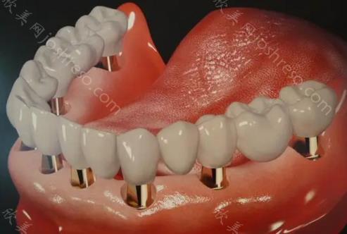 福州种植满口牙齿需要多少钱？福州全口种植牙好医院公布！
