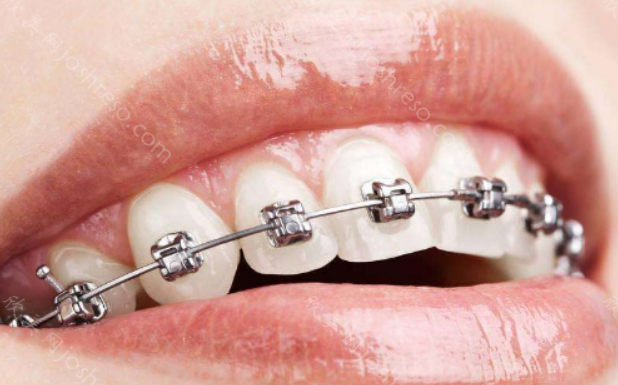 牙套的种类及价格表大全：看完你就知道选择哪种牙齿矫正器了
