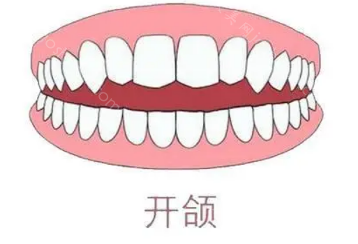 牙齿咬合的标准是怎么样的图：由此判断自己需不需要整牙