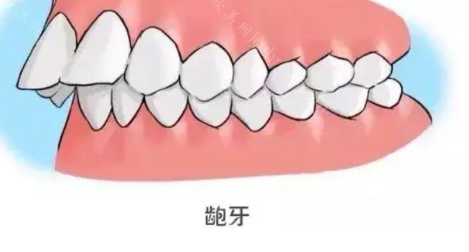 牙齿咬合的标准是怎么样的图：由此判断自己需不需要整牙