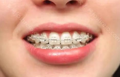 厦门牙齿矫正价格公布？分享厦门各项矫正器多少钱？