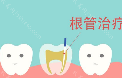 牙齿根管治疗费用一般多少钱?影响牙根管治疗收费标准有哪些?