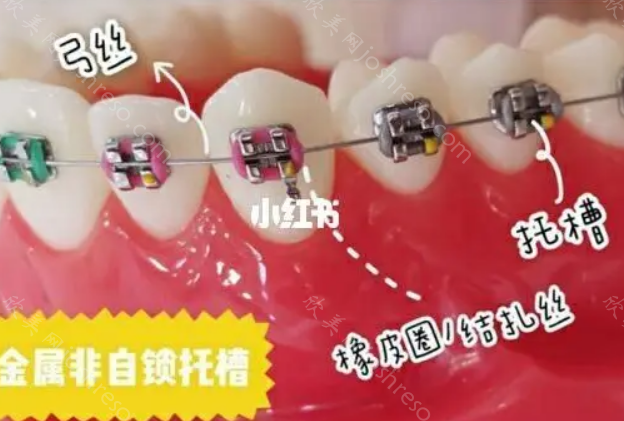 深圳贝尔口腔金属自锁价格多少钱?据说很便宜，价格表一览