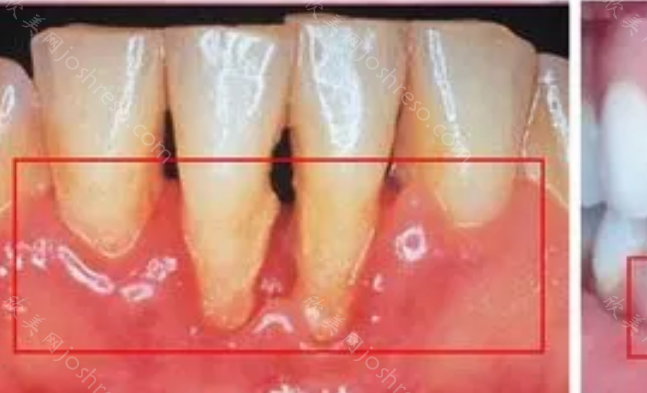 怎么判断自己是牙槽骨增生?牙槽骨增生图片呈现