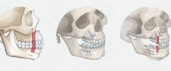 正颌手术方式有多少种?正颌手术费用解析!