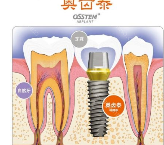 深圳同步齿科种植牙好在哪里?技术优势明显价格还不贵