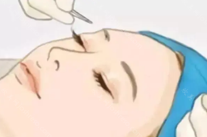深圳美莱眼睛谁做的好?优质口碑医生推荐