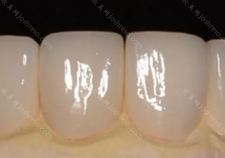 门牙做瓷贴面可以维持多久?全瓷贴面多少钱呢?