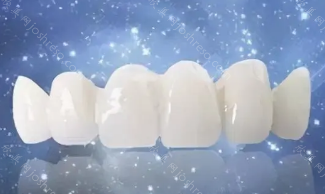 门牙做瓷贴面可以维持多久?全瓷贴面多少钱呢?
