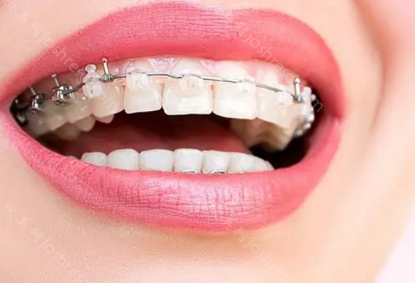 西安唯尔口腔价格表：唯尔口腔矫正牙齿8000，种牙2000元起