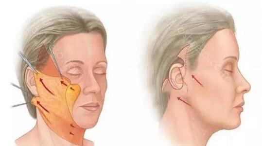 拉皮手术为什么耳朵容易变形?拉皮手术费用,避免后遗症好方法!