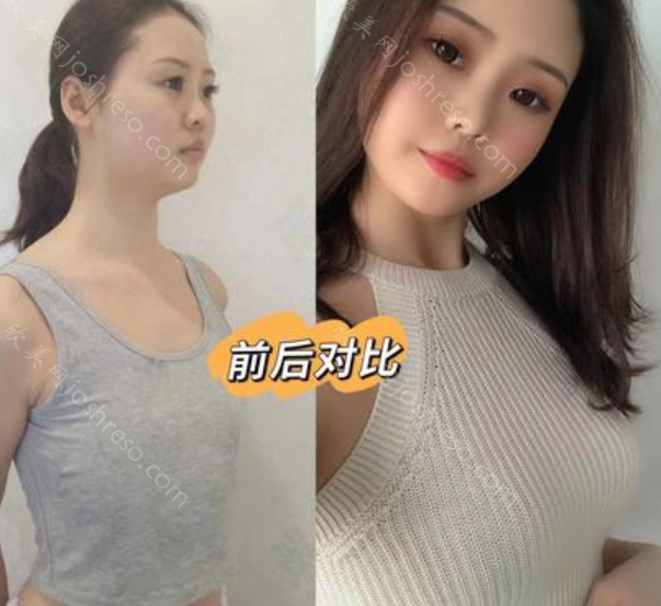 南京美莱隆胸怎么样?房志强医生假体隆胸30000起