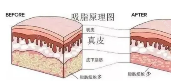 南京康美吸脂技术怎么样?哪些医生比较擅长呢?