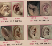 儿童单侧耳朵畸形矫正多大年龄矫正好？需要多少钱