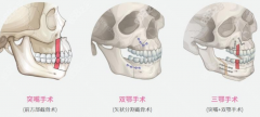 地包天做正颌手术费用多少?难度大吗?