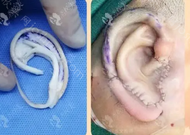耳朵再造大扩张手术，手术的过程与意义