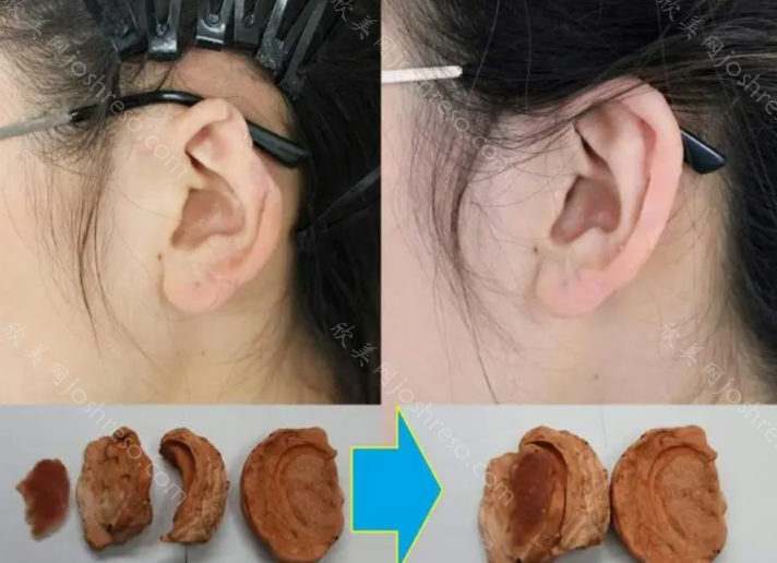 耳朵缺损修复多少钱?医保报销多少？