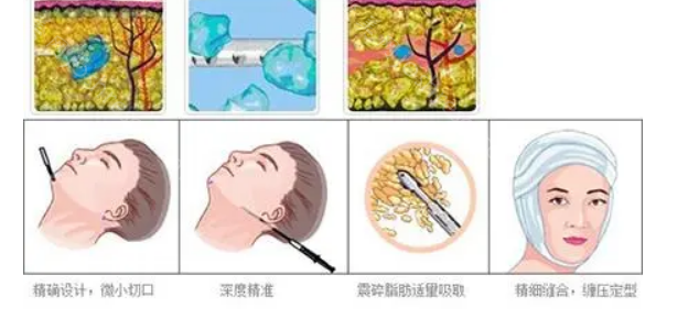 面部吸脂武汉哪家医院好?华美、仁爱时光等实力在线对比