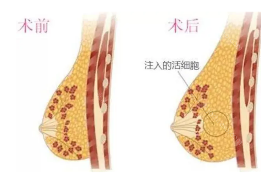 成都艺星整形隆胸怎么样?曹士华、韩春等医生隆胸自然