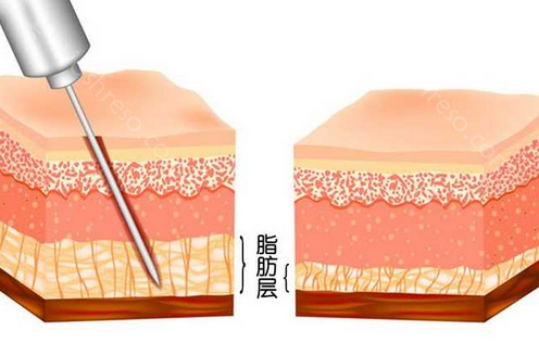 北京八大处医疗吸脂技术好的医生:刘春军/解芳/张超医生等名列前茅!