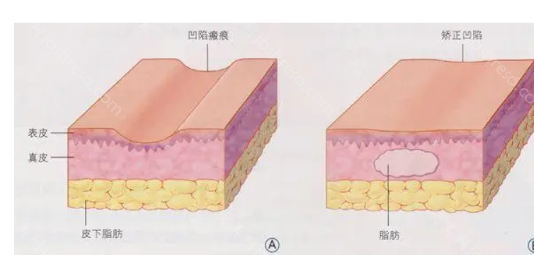 成都铜雀台医学美容医院吸脂怎么样?朱慧东院长吸脂技术好