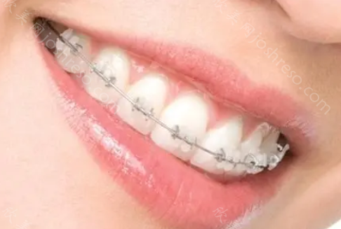 牙齿矫正，过程中有不适感吗？矫正结束后又会面对的一系列问题！