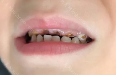 大牙烂到什么程度必须拔牙图片！大牙烂到了一定的程度，就有可能出现剧烈的