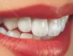 牙不齐能做牙齿贴面改善吗?贴面会导致嘴凸吗,贴面费用!