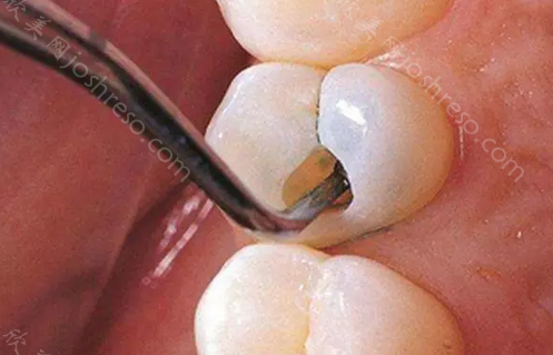 小孩补牙多少钱一颗牙?小孩子补牙费用影响因素,乳牙补牙对恒牙的影响!
