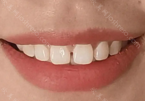 牙缝太大总塞牙怎么彻底解决?可以使用牙线、牙缝刷，牙缝隙填充剂等