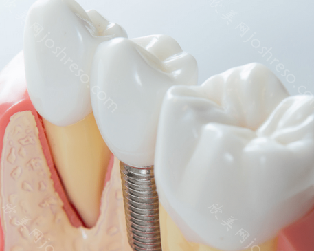 种植牙一期二期三期流程是什么?一文带你了解种植牙全过程!