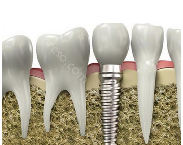 种植牙一期二期三期流程是什么?一文带你了解种植牙全过程!