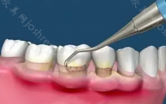 牙周刮治后，牙龈萎缩的原因和治疗方法