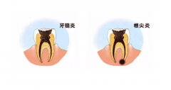 根尖炎和牙髓炎的区别及治疗方法
